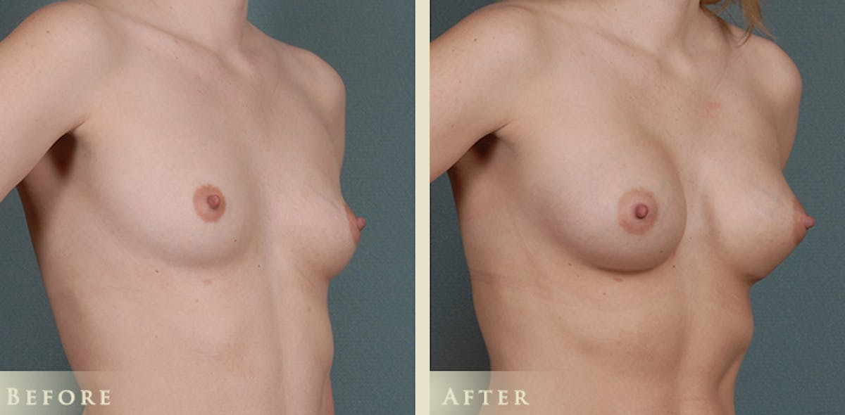 Breast Augmentation with Anatomical Silicone Implants Before & After Gallery - Patient 410457 - Image 2