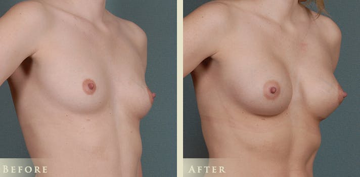Breast Augmentation Before & After Gallery - Patient 256033 - Image 2