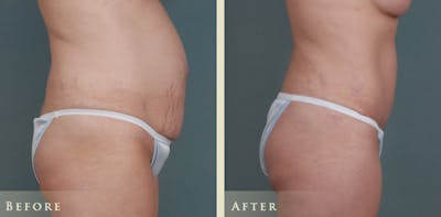 Mommy Makeover Before & After Gallery - Patient 191043 - Image 3