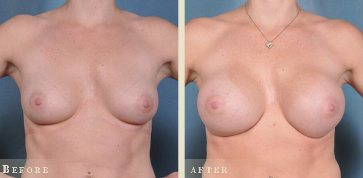 Breast Augmentation with Silicone Implants Before & After Gallery - Patient 241697 - Image 1