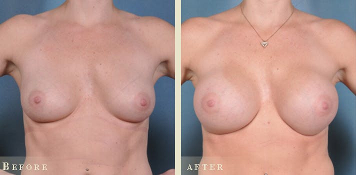 Breast Augmentation Before & After Gallery - Patient 241697 - Image 1