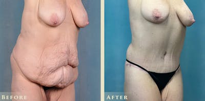 Body Lift Before & After Gallery - Patient 182955 - Image 4