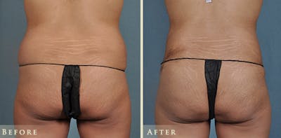 Brazilian Butt Lift Before & After Gallery - Patient 428851 - Image 1