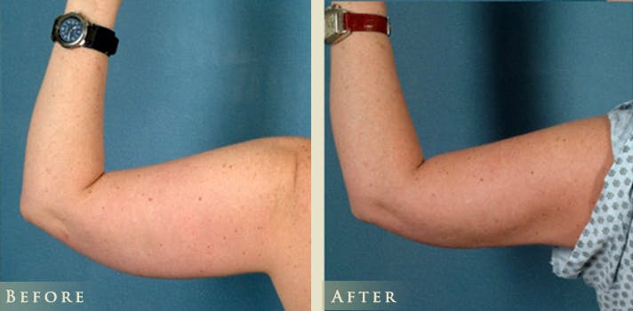 Female Liposuction Before & After Gallery - Patient 804496 - Image 1