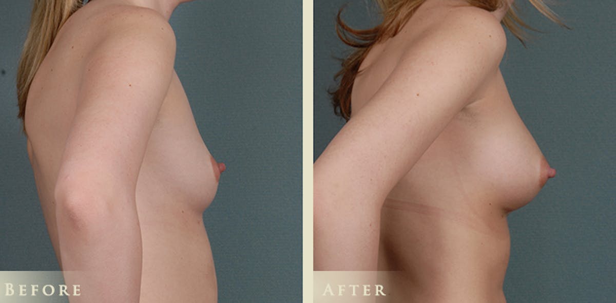 Breast Augmentation with Anatomical Silicone Implants Before & After Gallery - Patient 410457 - Image 3