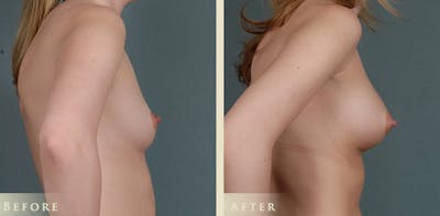 Breast Augmentation Before & After Gallery - Patient 256033 - Image 3