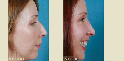 Aesthetic Rhinoplasty Before & After Gallery - Patient 143704 - Image 3