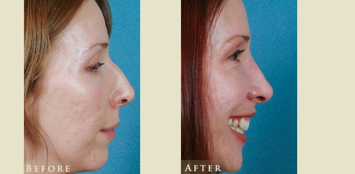Aesthetic Rhinoplasty Before & After Gallery - Patient 143704 - Image 3