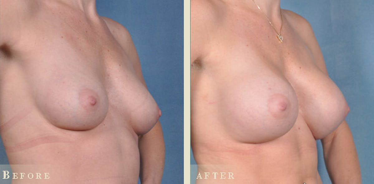 Breast Augmentation with Silicone Implants Before & After Gallery - Patient 241697 - Image 2