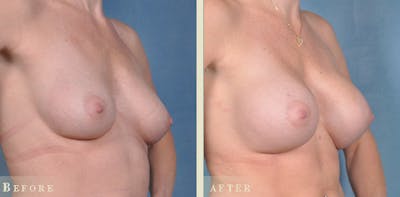 Breast Augmentation Before & After Gallery - Patient 241697 - Image 2