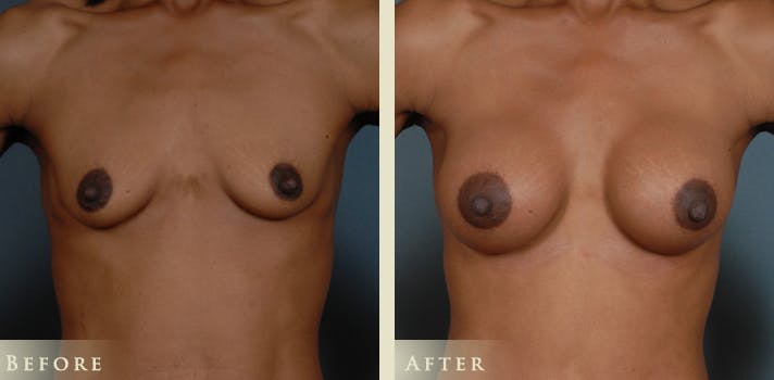 Mommy Makeover Before & After Gallery - Patient 338837 - Image 1