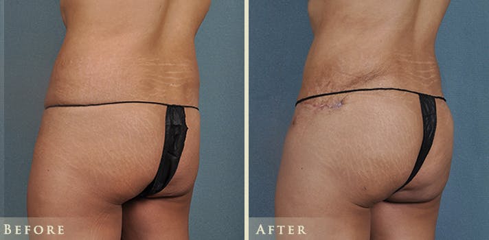 Tummy Tuck Before & After Gallery - Patient 121832 - Image 5