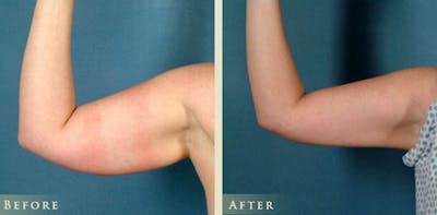 Female Liposuction Before & After Gallery - Patient 804496 - Image 2
