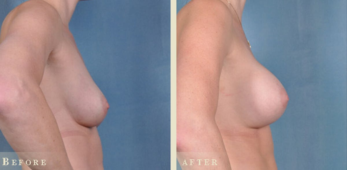 Breast Augmentation with Silicone Implants Before & After Gallery - Patient 241697 - Image 3