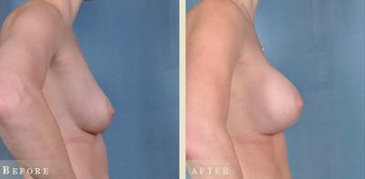 Breast Augmentation Before & After Gallery - Patient 241697 - Image 3