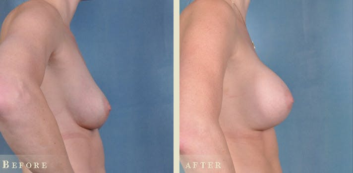 Breast Augmentation Before & After Gallery - Patient 241697 - Image 3