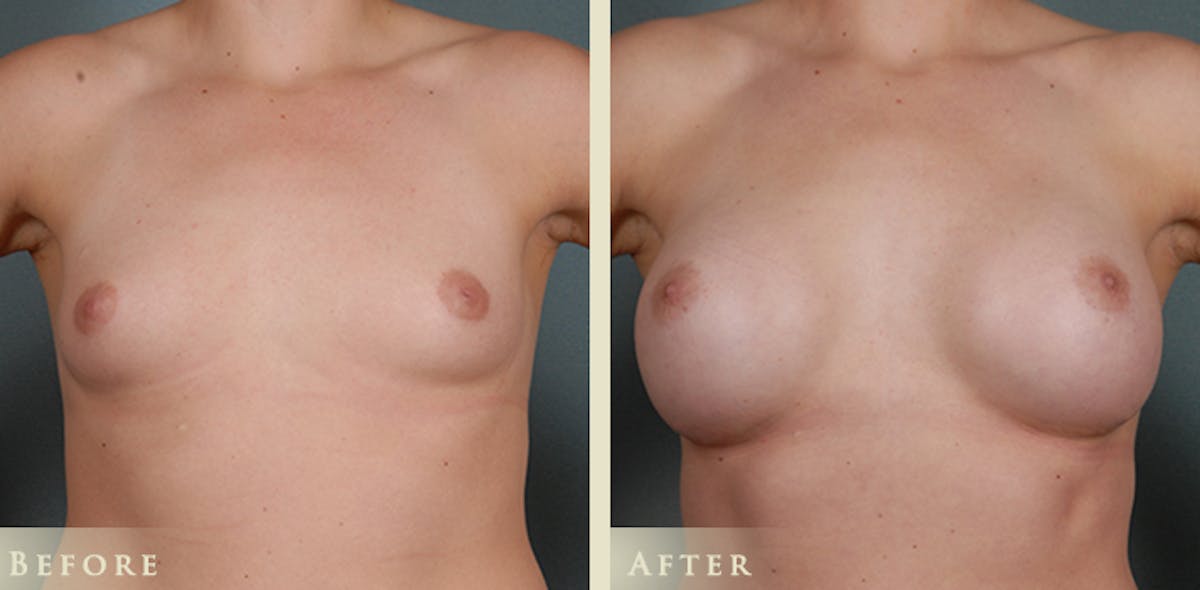 Breast Augmentation with Anatomical Silicone Implants Before & After Gallery - Patient 241911 - Image 1