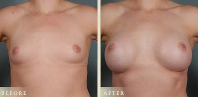 Breast Augmentation Before & After Gallery - Patient 340634 - Image 1