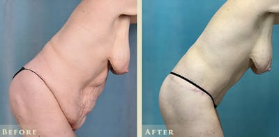 Body Lift Before & After Gallery - Patient 182955 - Image 6