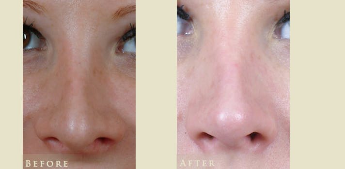 Aesthetic Rhinoplasty Before & After Gallery - Patient 221902 - Image 1