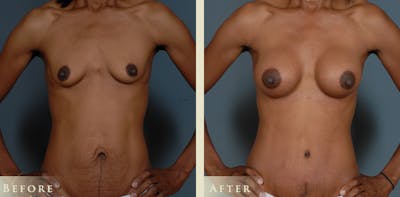 Mommy Makeover Before & After Gallery - Patient 338837 - Image 2