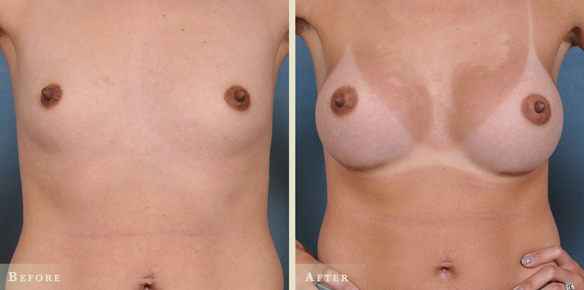 Breast Augmentation with Saline Implants Before & After Gallery - Patient 381985 - Image 1