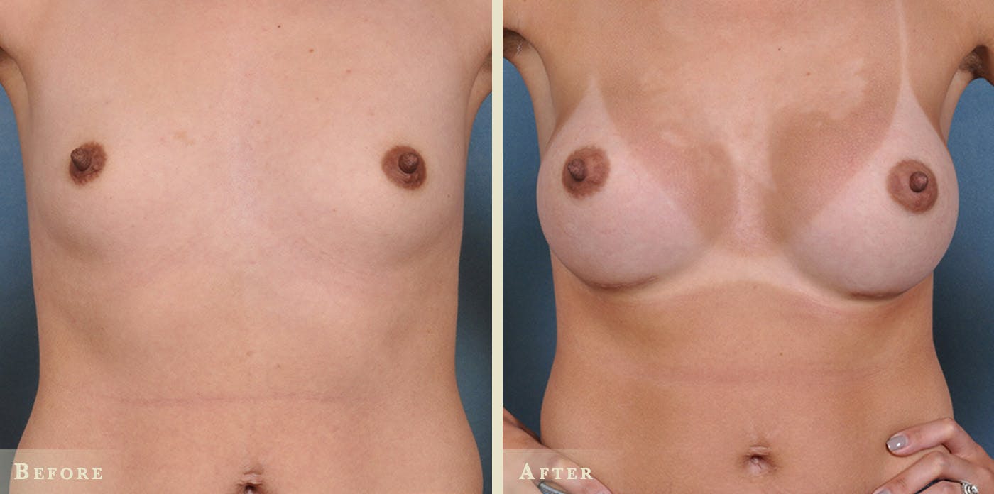 Breast Augmentation Before & After Gallery - Patient 369931 - Image 1