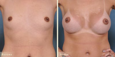 Breast Augmentation Before & After Gallery - Patient 369931 - Image 1