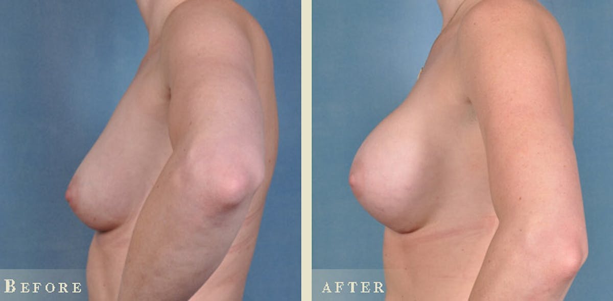 Breast Augmentation with Silicone Implants Before & After Gallery - Patient 241697 - Image 4