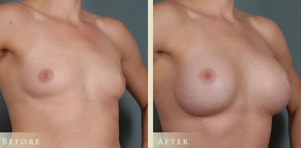 Breast Augmentation with Anatomical Silicone Implants Before & After Gallery - Patient 241911 - Image 2