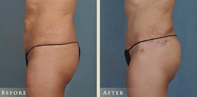 Brazilian Butt Lift Before & After Gallery - Patient 428851 - Image 3