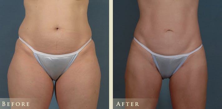 Female Liposuction Before & After Gallery - Patient 207953 - Image 1