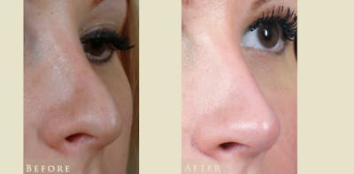 Aesthetic Rhinoplasty Before & After Gallery - Patient 221902 - Image 2