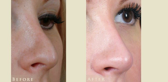 Aesthetic Rhinoplasty Before & After Gallery - Patient 221902 - Image 2