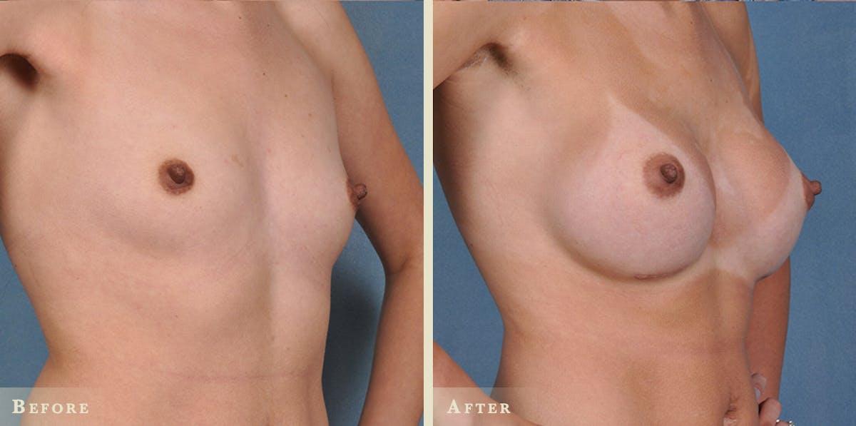 Breast Augmentation with Saline Implants Before & After Gallery - Patient 381985 - Image 2