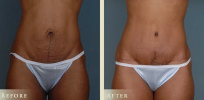 Mommy Makeover Before & After Gallery - Patient 338837 - Image 3