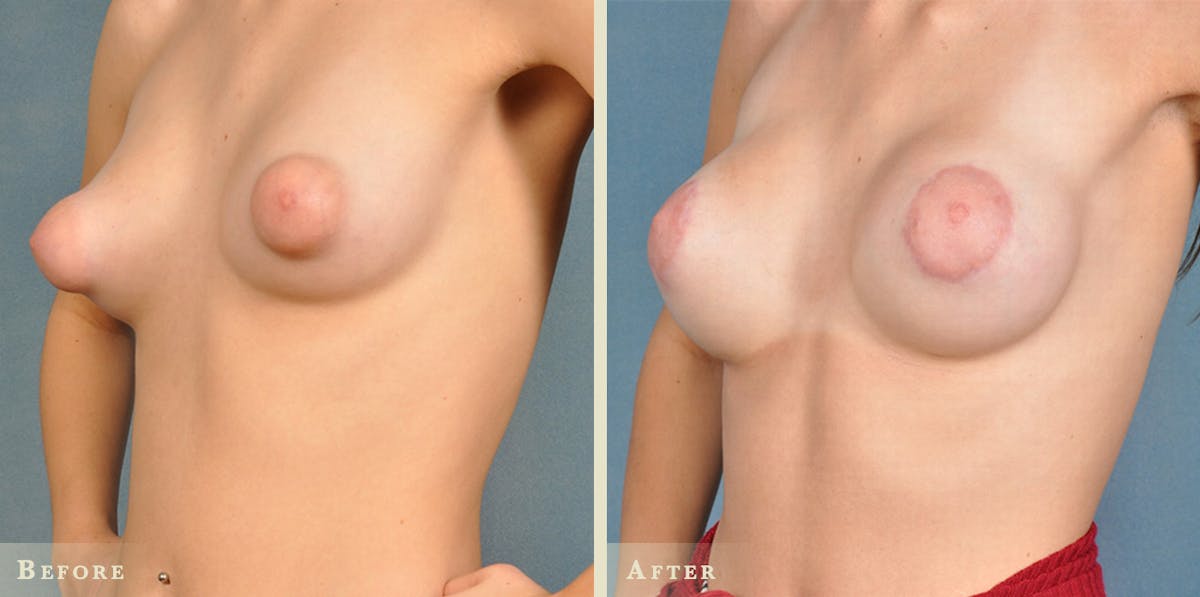 Breast Augmentation with Silicone Implants Before & After Gallery - Patient 208904 - Image 1