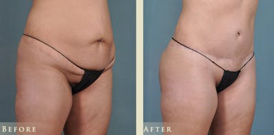 Tummy Tuck Before & After Gallery - Patient 176365 - Image 2