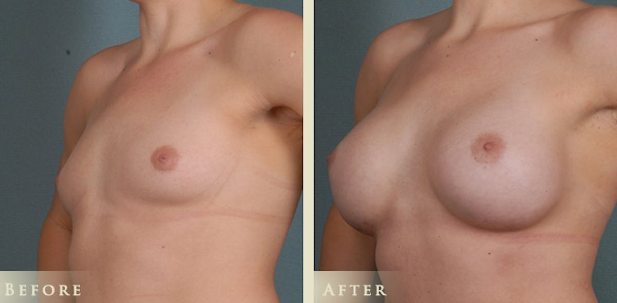 Breast Augmentation with Anatomical Silicone Implants Before & After Gallery - Patient 241911 - Image 3