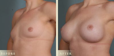 Breast Augmentation Before & After Gallery - Patient 340634 - Image 3