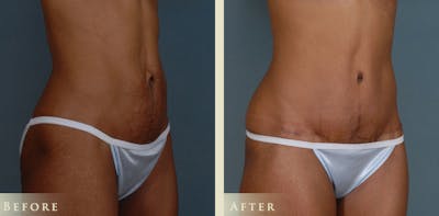 Mommy Makeover Before & After Gallery - Patient 338837 - Image 4