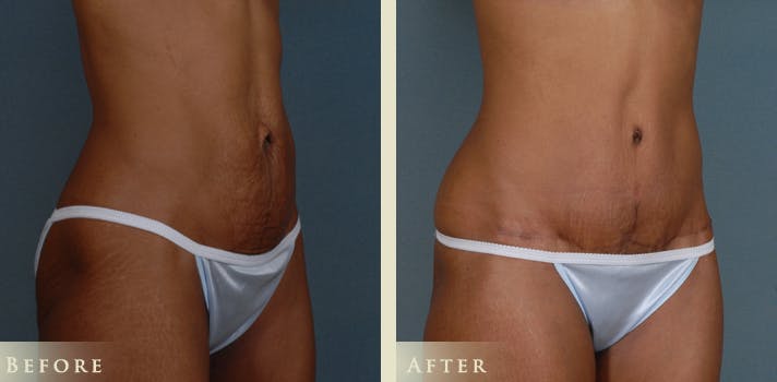 Mommy Makeover Before & After Gallery - Patient 338837 - Image 4