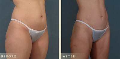 Female Liposuction Before & After Gallery - Patient 207953 - Image 2
