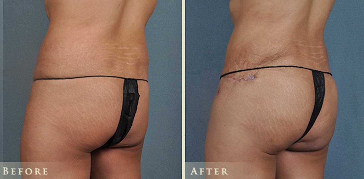 Brazilian Butt Lift Before & After Gallery - Patient 428851 - Image 4