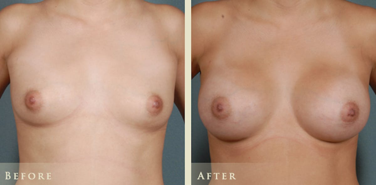 Breast Augmentation with Saline Implants Before & After Gallery - Patient 414123 - Image 1