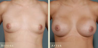 Breast Augmentation Before & After Gallery - Patient 218421 - Image 1