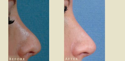 Aesthetic Rhinoplasty Before & After Gallery - Patient 221902 - Image 3