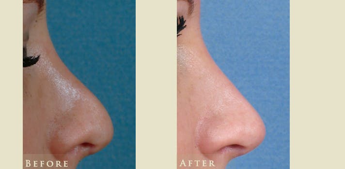 Aesthetic Rhinoplasty Before & After Gallery - Patient 221902 - Image 3