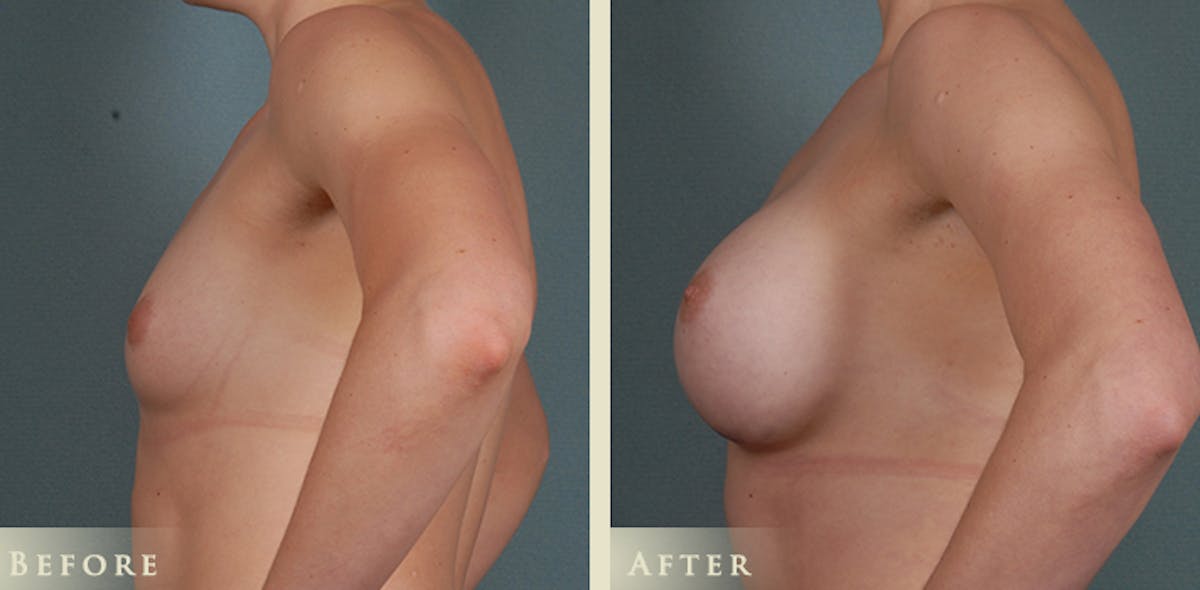 Breast Augmentation with Anatomical Silicone Implants Before & After Gallery - Patient 241911 - Image 4