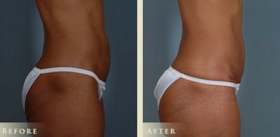 Mommy Makeover Before & After Gallery - Patient 338837 - Image 5